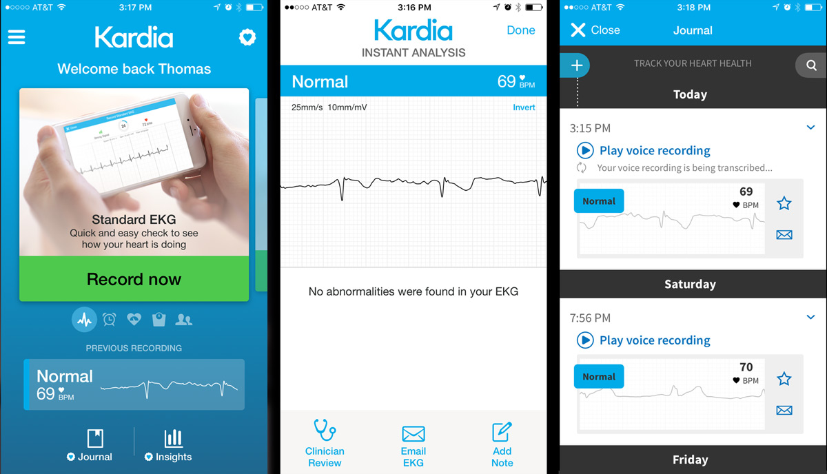 AliveCor Review - PVCs and PACs and AFib